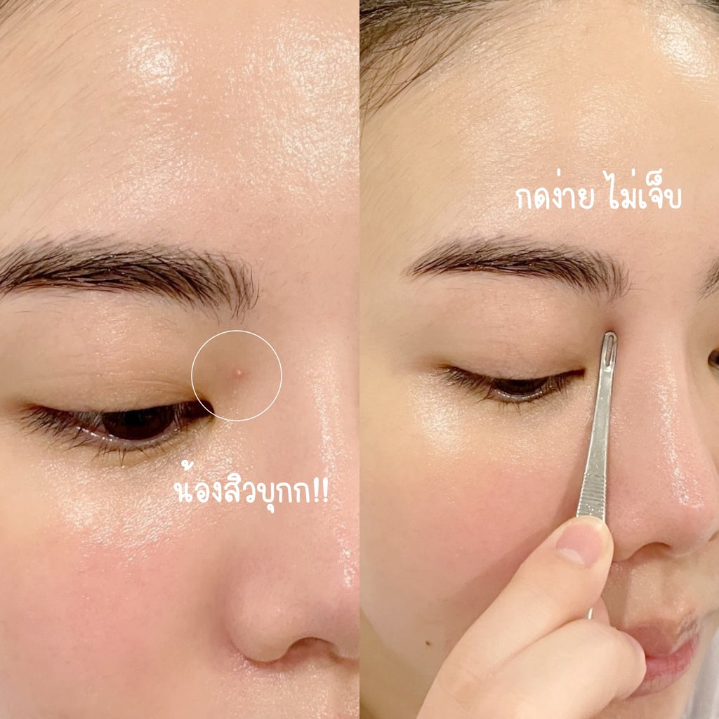 COMEDONE Extractor with free items ไม้กดสิว หมอมวลชน