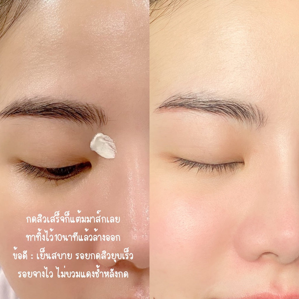 COMEDONE Extractor with free items ไม้กดสิว หมอมวลชน