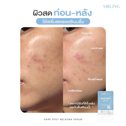 Sibling Dark Spot Melasma Serum 15ml