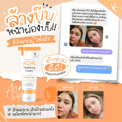 VC Vitamin C Acne White Foam 50g